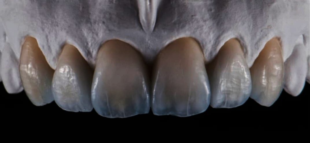 Anterior veneers on the model