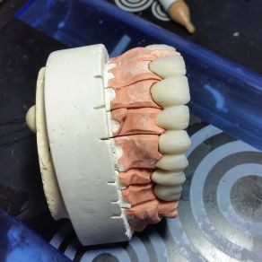 Full arch on the articulator