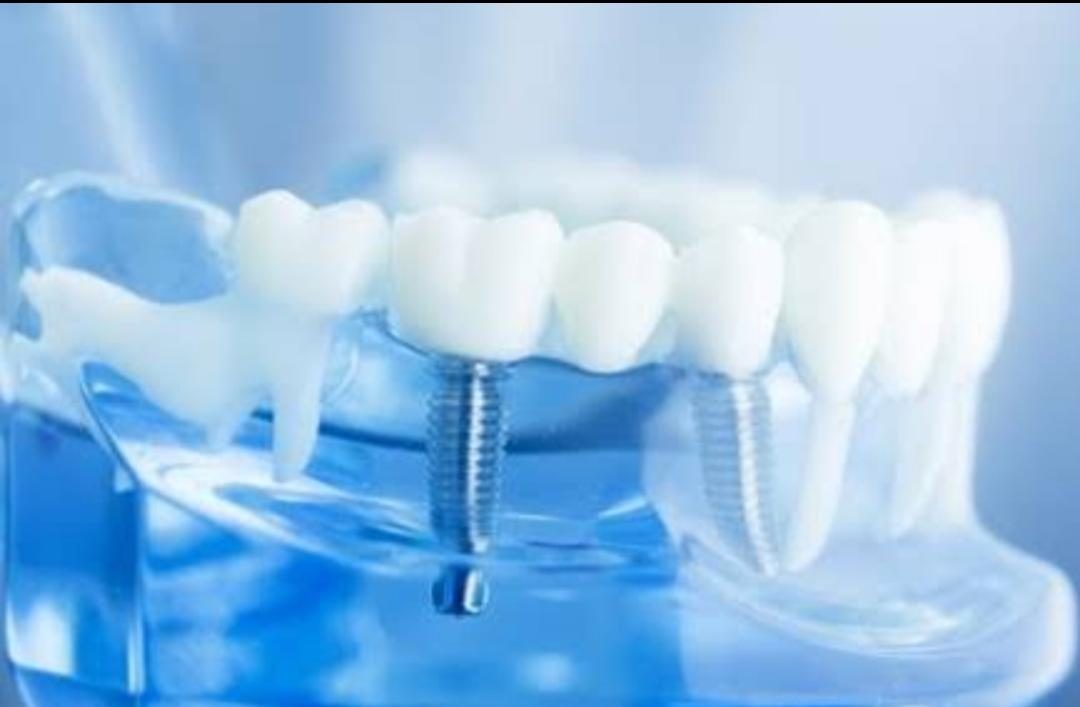 Implant Prosthetics