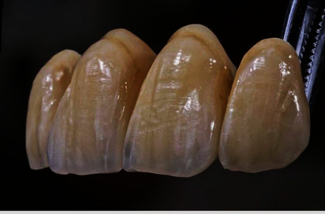 Layered ceramic anteriors