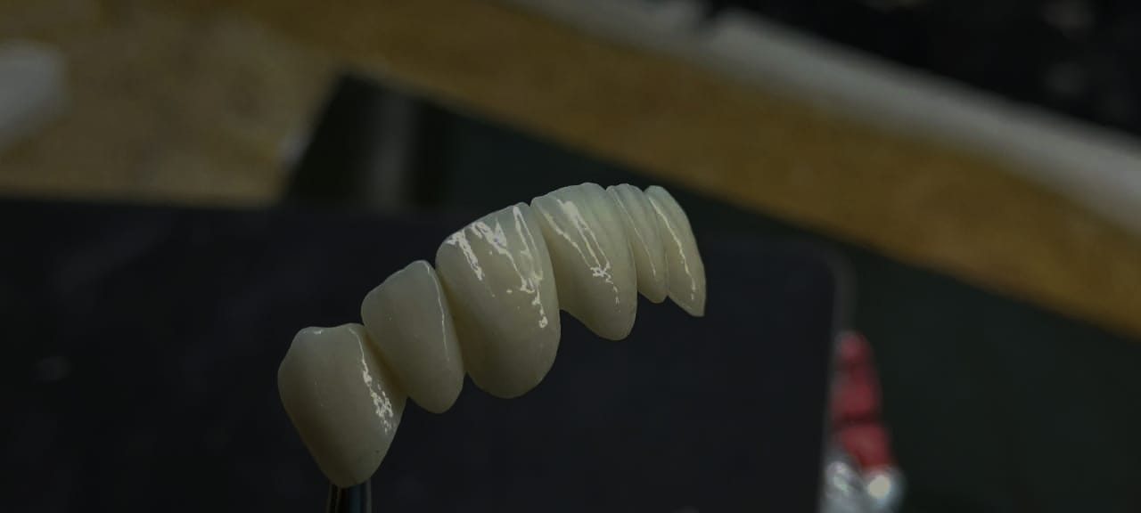 Posterior bridge
